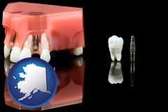 alaska map icon and a titanium dental implant and wisdom tooth