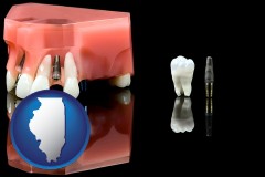 illinois map icon and a titanium dental implant and wisdom tooth