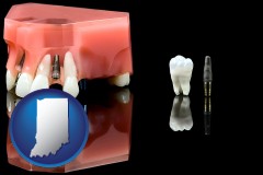 indiana map icon and a titanium dental implant and wisdom tooth