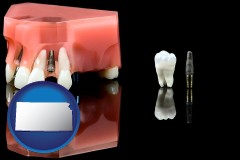 kansas map icon and a titanium dental implant and wisdom tooth