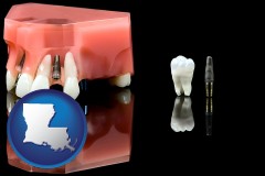 louisiana map icon and a titanium dental implant and wisdom tooth