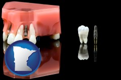minnesota map icon and a titanium dental implant and wisdom tooth