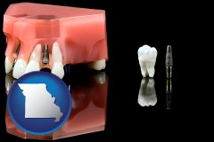 missouri map icon and a titanium dental implant and wisdom tooth