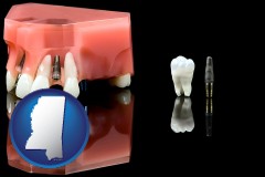 mississippi map icon and a titanium dental implant and wisdom tooth