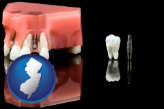 new-jersey map icon and a titanium dental implant and wisdom tooth