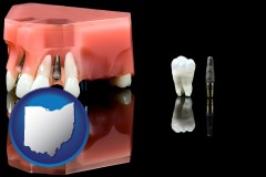 ohio map icon and a titanium dental implant and wisdom tooth
