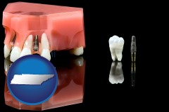 tennessee map icon and a titanium dental implant and wisdom tooth