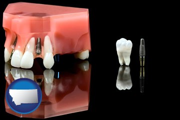 a titanium dental implant and wisdom tooth - with Montana icon