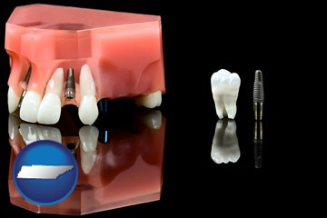 a titanium dental implant and wisdom tooth - with Tennessee icon