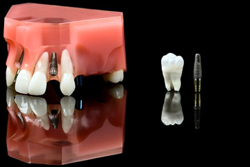 a titanium dental implant and wisdom tooth